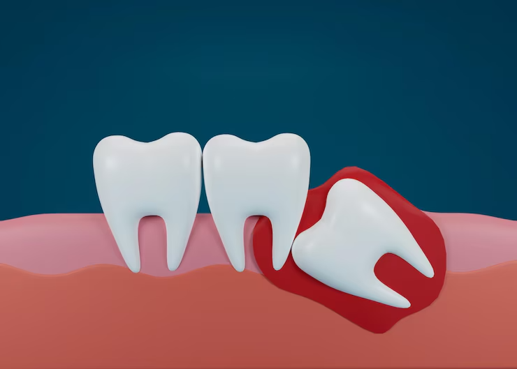 Impaction