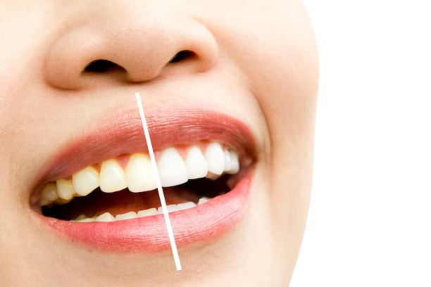 Teeth whitening in Pondicherry