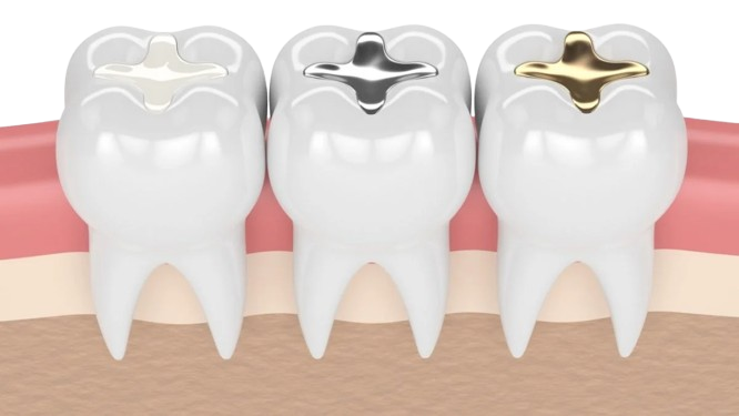 Tooth Filling in Pondicherry