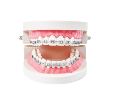 6 Month Braces Cost In Pondicherry 6 Month Braces Cost In Pondicherry