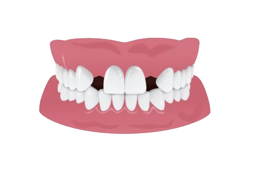 Teeth Gap Filling Cost In Pondicherry